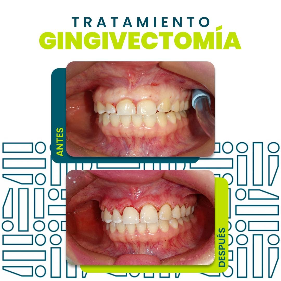 GingivectomÃ­a