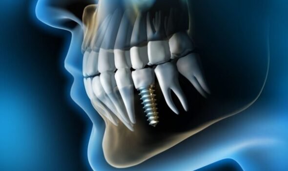 digital-image-of-teeth-and-jaw-with-dental-implant