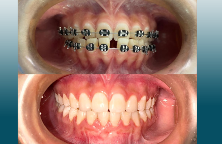 Antes y Después – Tratamiento de Ortodoncia 13